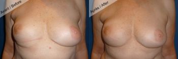 Lipomodelage malformation des seins