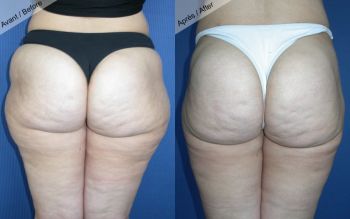 Liposuccion cuisses et hanches