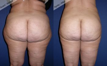 Liposuccion cuisses et hanches