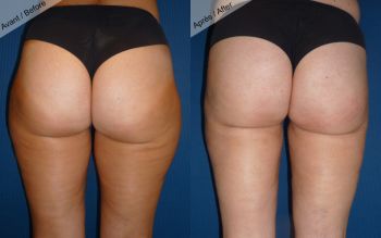 Liposuccion culotte de cheval