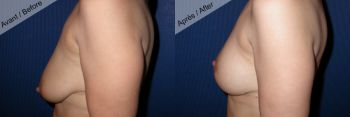 Prothèse mammaire et lifting cicatrice en T