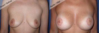 Prothèse mammaire et lifting cicatrice péri aréolaire
