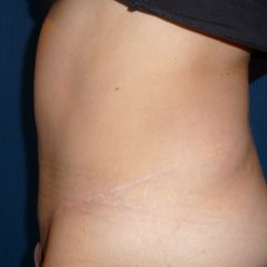 Abdominoplastie après