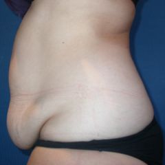 Abdominoplastie avant