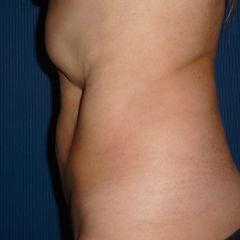 Coolsculpting après