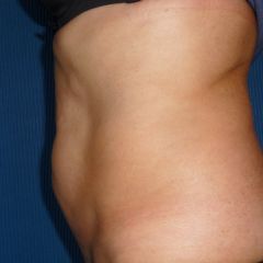 Coolsculpting before