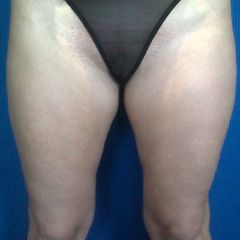 Coolsculpting cuisses après