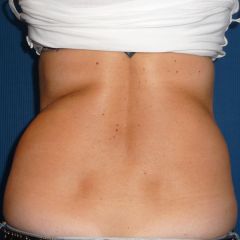 Coolsculpting hanches avant