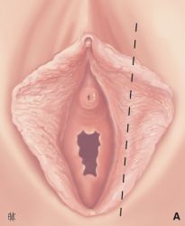 Nymphoplasty