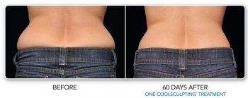 Before and after