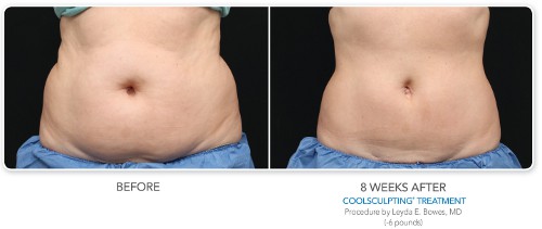 Photos avant / après coolsculpting