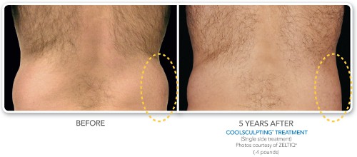 Photos avant / après coolsculpting