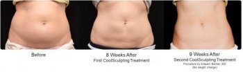 Results Coolsculpting