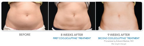 Photos avant / après coolsculpting