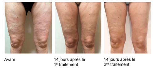 Résultat avant après du traitement de la cellulite sur les cuisses à Avignon