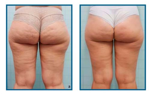 Résultat avant après du traitement de la cellulite sur les fesses à Avignon