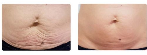 Résultat avant après traitement cellulite sur le ventre à Avignon