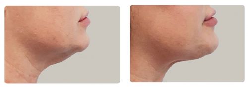 Résultat avant après du relachement de la peau sur le visage à Avignon